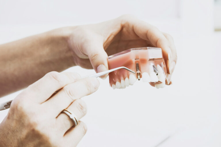 impianto dentale osso chirurgia