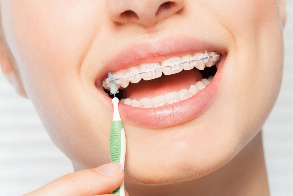 ortodonzia tradizionale apparecchio denti