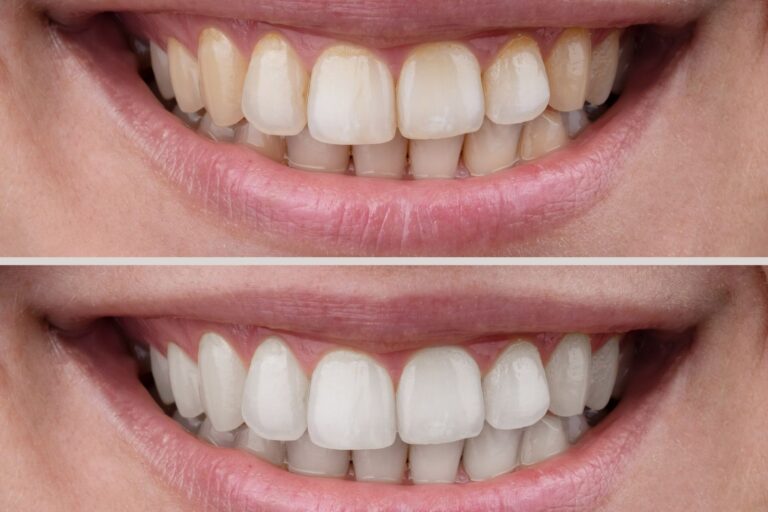 sbiancamento dentale busto arsizio pulizia denti professionale